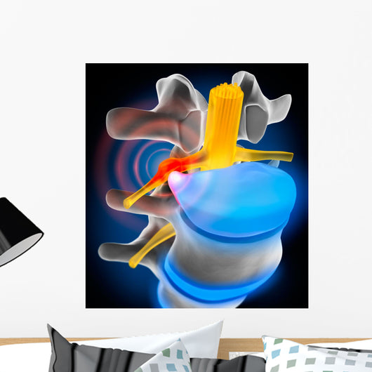 Bandscheibenvorfall Detail Wall Decal