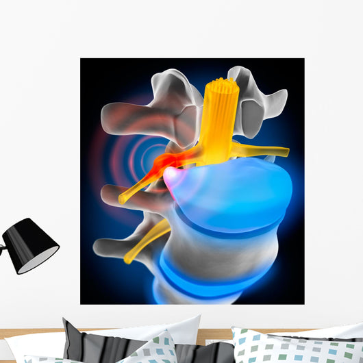 Bandscheibenvorfall Detail Wall Decal