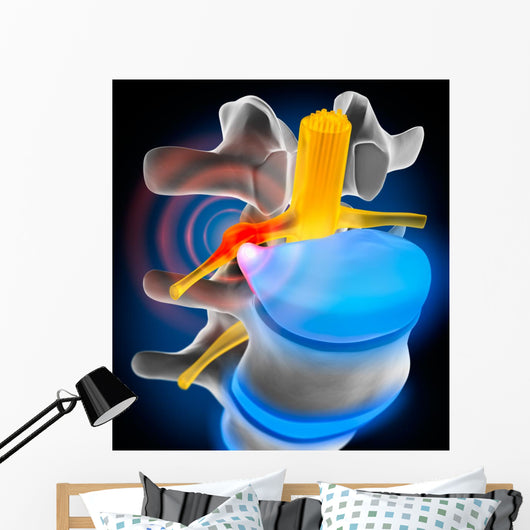 Bandscheibenvorfall Detail Wall Decal