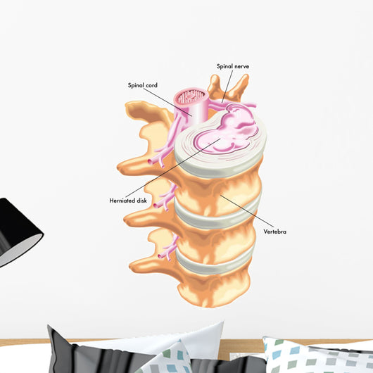 Herniated Disc Wall Decal