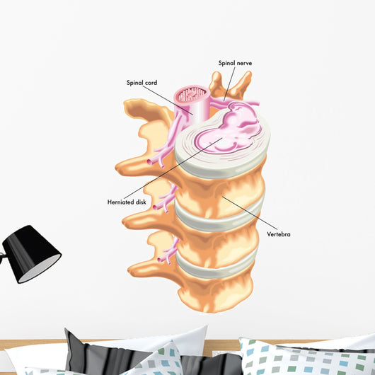 Herniated Disc Wall Decal