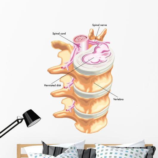 Herniated Disc Wall Decal