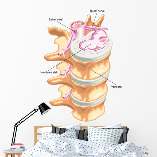 Herniated Disc Wall Decal
