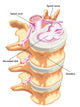 Herniated Disc Wall Decal