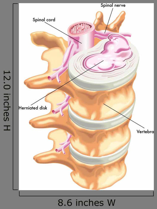 Herniated Disc Wall Decal
