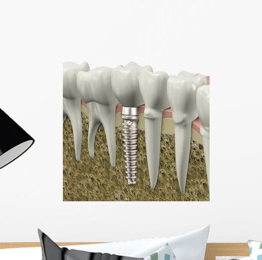 Dental Implant Wall Decal
