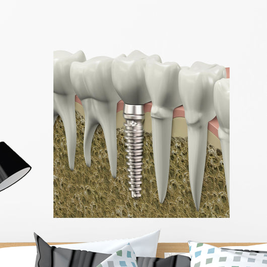 Dental Implant Wall Decal