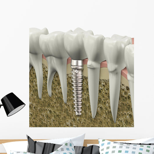 Dental Implant Wall Decal