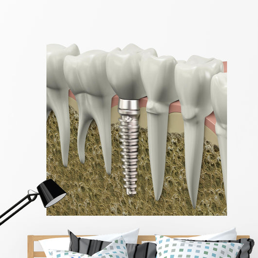Dental Implant Wall Decal