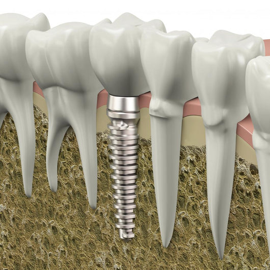 Dental Implant Wall Decal
