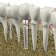 Dental Implant Wall Decal