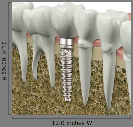 Dental Implant Wall Decal