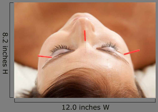 Anti-aging Acupuncture Treatment Wall Decal