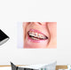 Teeth With Braces Wall Decal
