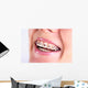 Teeth With Braces Wall Decal