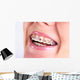 Teeth With Braces Wall Decal