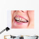 Teeth With Braces Wall Decal