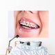 Teeth With Braces Wall Decal