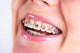 Teeth With Braces Wall Decal