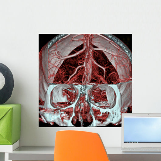 Mri Mra Brain Vasculature Wall Decal