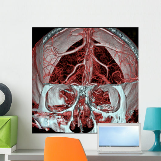 Mri Mra Brain Vasculature Wall Decal