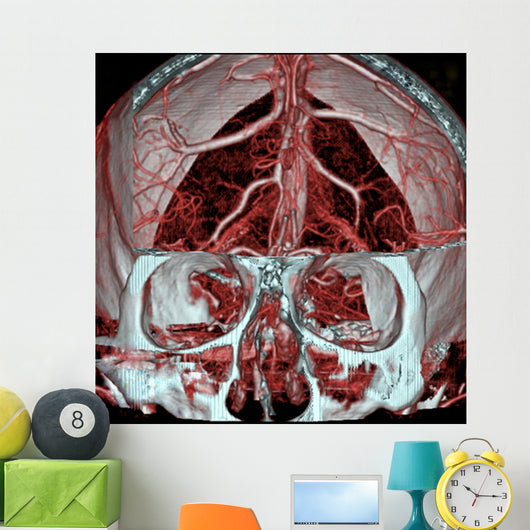 Mri Mra Brain Vasculature Wall Decal
