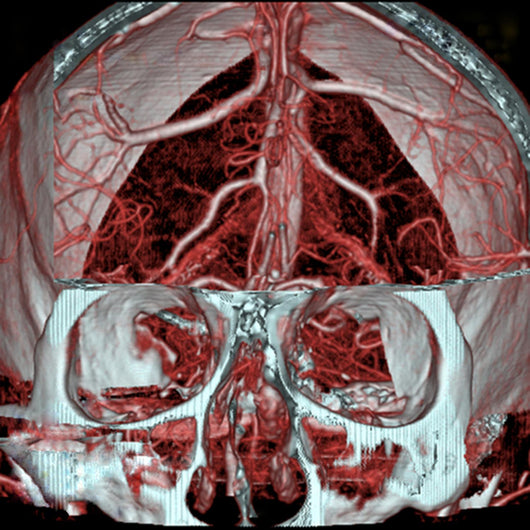 Mri Mra Brain Vasculature Wall Decal