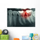 Dental Xray With Red Wall Decal