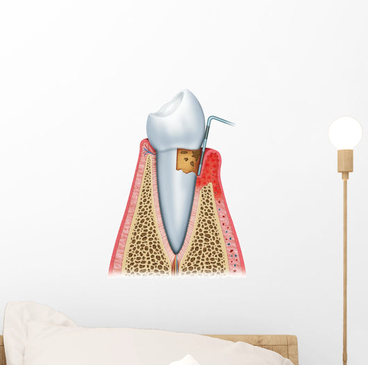 Periodontitis Half Wall Decal