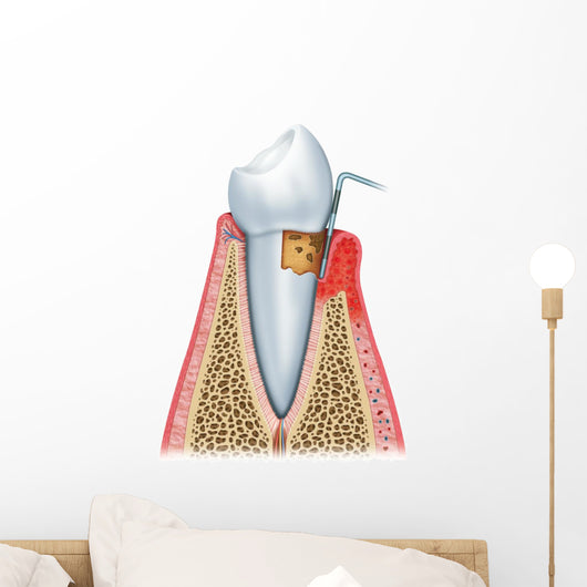 Periodontitis Half Wall Decal