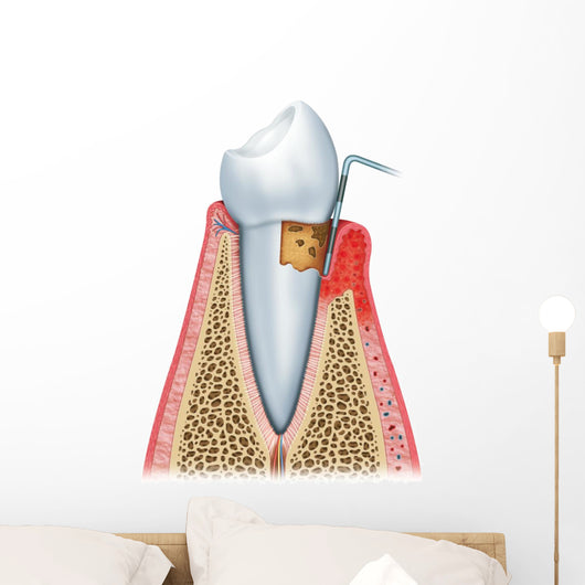 Periodontitis Half Wall Decal