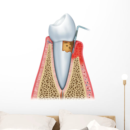 Periodontitis Half Wall Decal