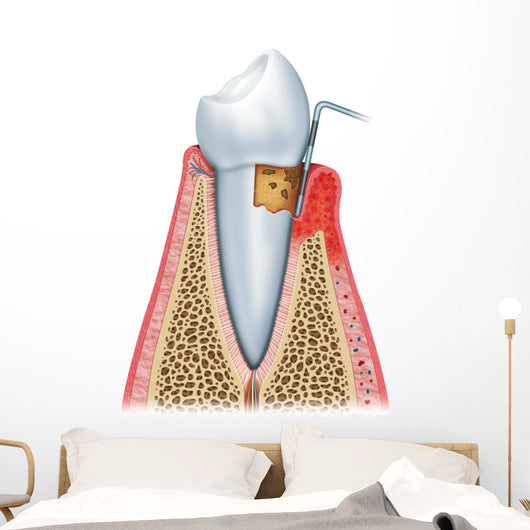 Periodontitis Half Wall Decal