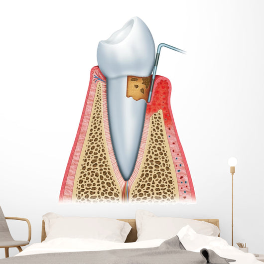Periodontitis Half Wall Decal