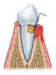 Periodontitis Half Wall Decal