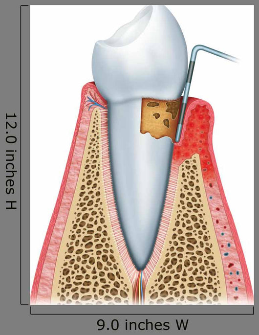Periodontitis Half Wall Decal