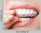 Teeth with Whitening Tray