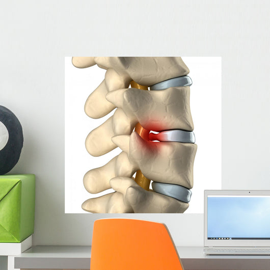 Disc Herniated
