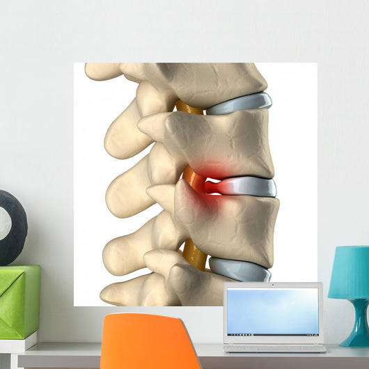 Disc Herniated