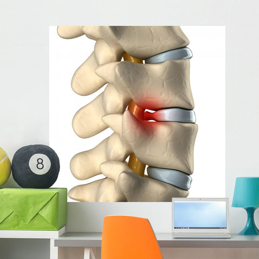 Disc Herniated