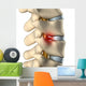 Disc Herniated