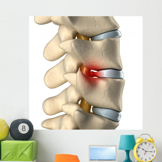 Disc Herniated