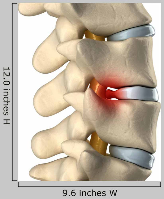 Disc Herniated