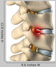 Disc Herniated