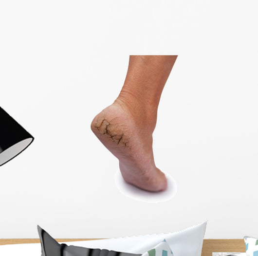 Chapped Heel