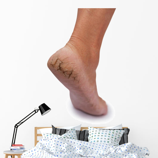 Chapped Heel