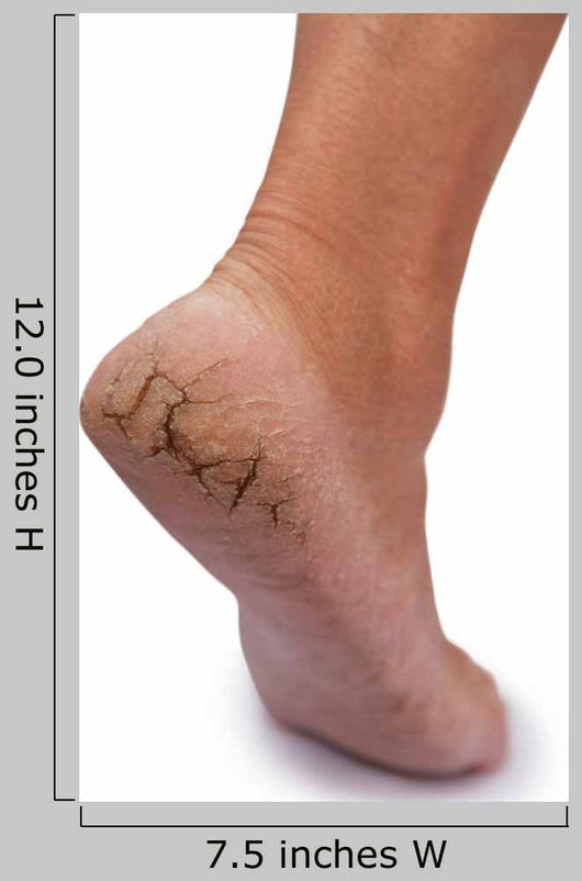 Chapped Heel