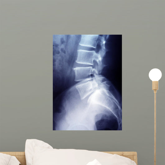 Lumbar Spine X-ray Image