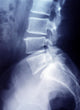 Lumbar Spine X-ray Image