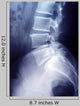 Lumbar Spine X-ray Image